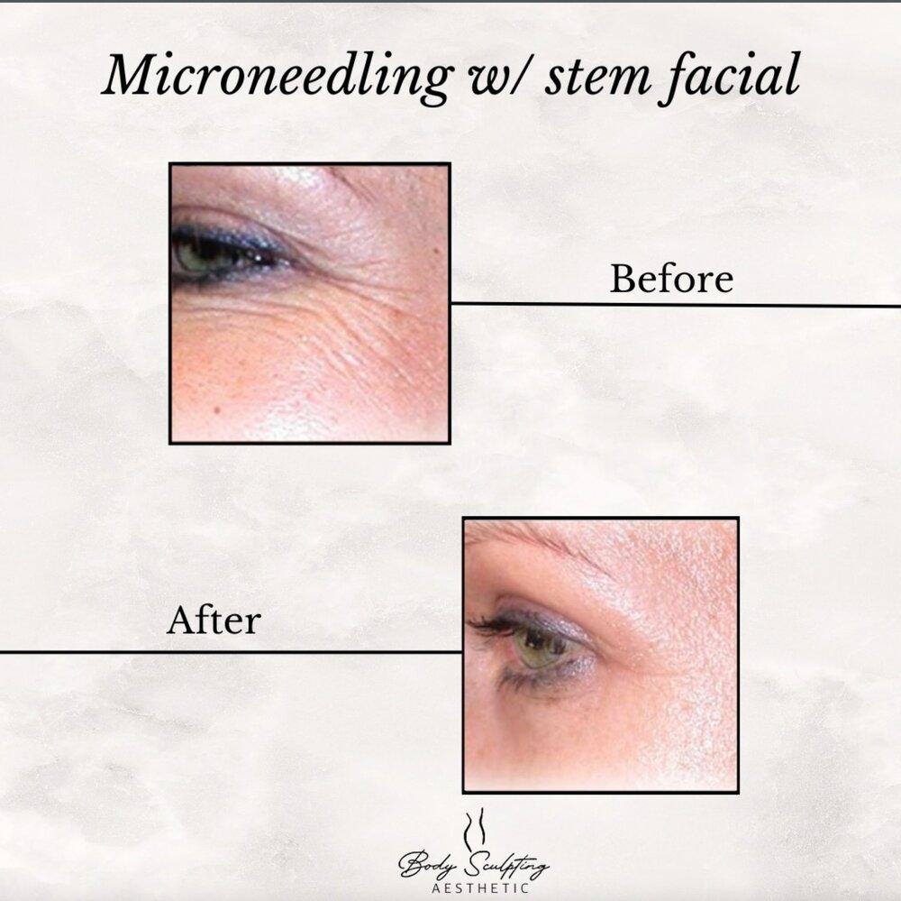 Microneedling with stem facial before and after